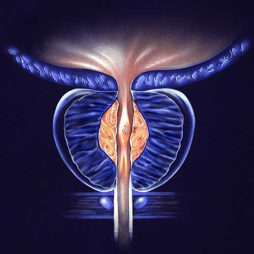 Cross-section illustration of stage 1 benign prostatic hyperplasia