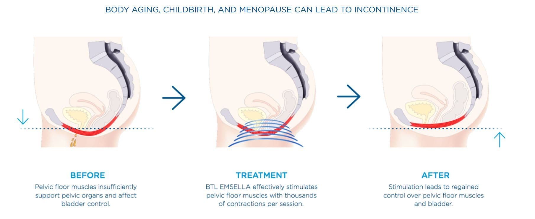 Chart comparing common Kegel exercise muscle contractions with BTL EMSELLA supramaximal contractions over time