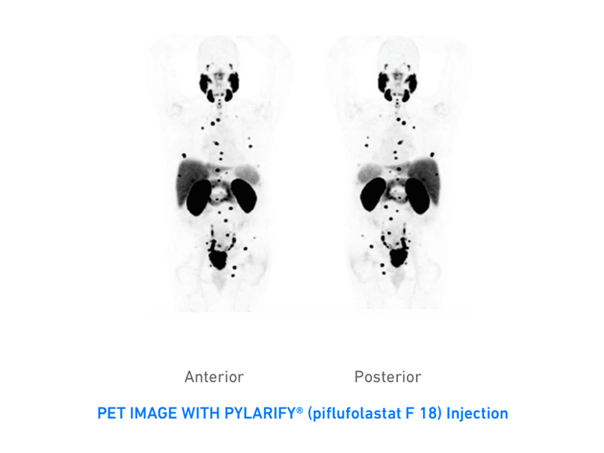 PYLARIFY PET image representing the Piflufolastat F18 prostate cancer registry study