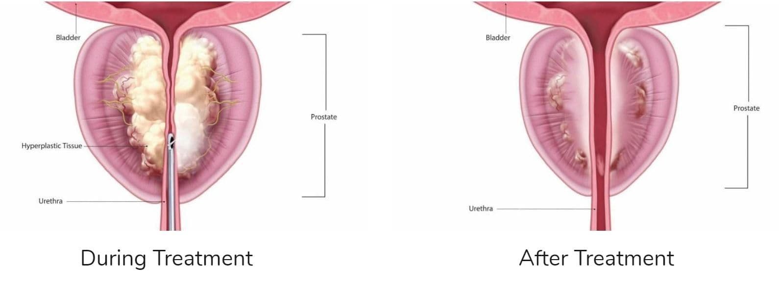 Rezūm water vapor therapy: prostate cross-sections showing anatomy and steam delivery