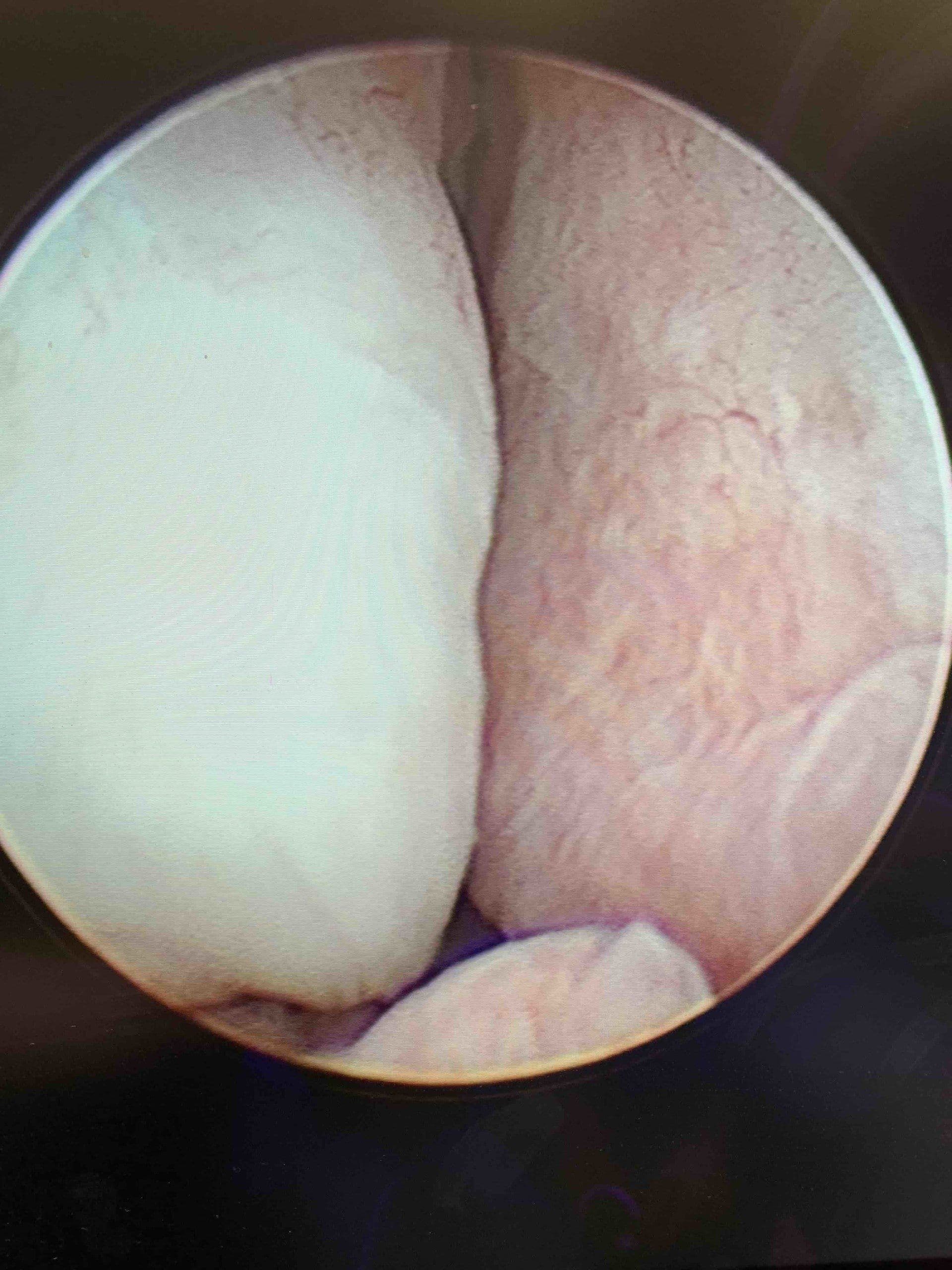 Endoscopic view before UroLift: narrowed passage from enlarged prostate