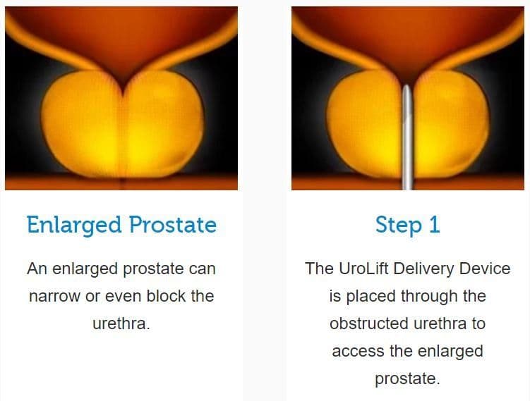 Medical illustrations: enlarged prostate narrowing the urethra, and the UroLift delivery device in place
